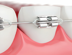 Orthodontic